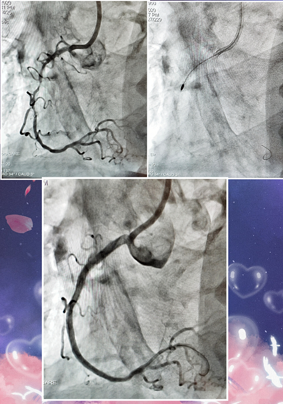 上海微创：FireRaptor冠脉旋磨系统获批上市